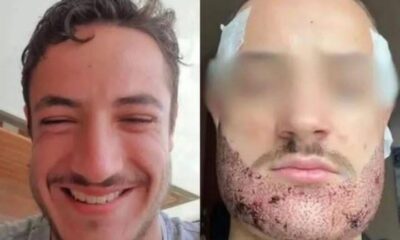 Mathieu Vigier Latour, a 24-year-old student from France, tragically ended his life after an unsuccessful beard transplant...see more