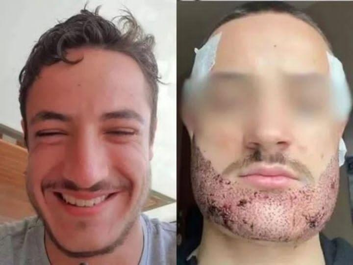 Mathieu Vigier Latour, a 24-year-old student from France, tragically ended his life after an unsuccessful beard transplant...see more